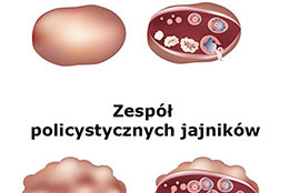 Zespół policystycznych jajników (PCOS) 
