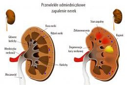 Odmiedniczkowe zapalenie nerek 