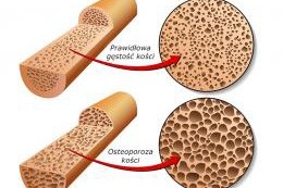 Osteoporoza 