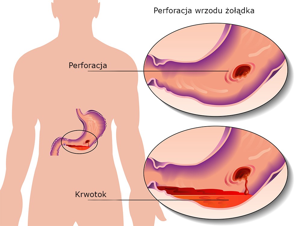 perforacja