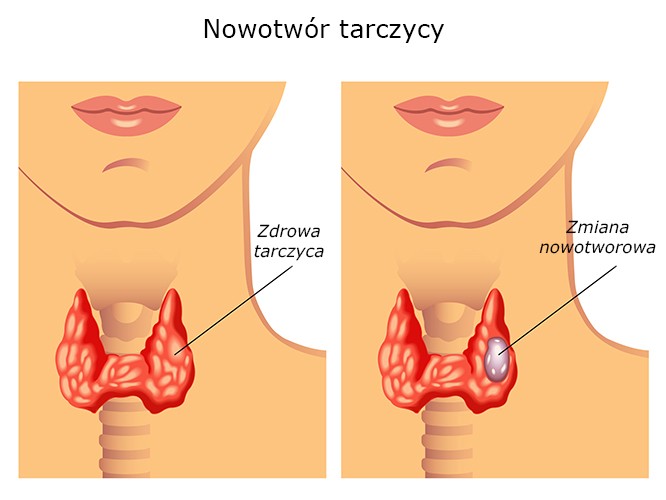 rak tarczycy endokrynolog