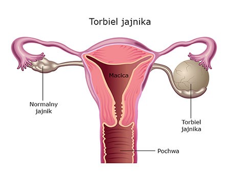 torbiel jajnika