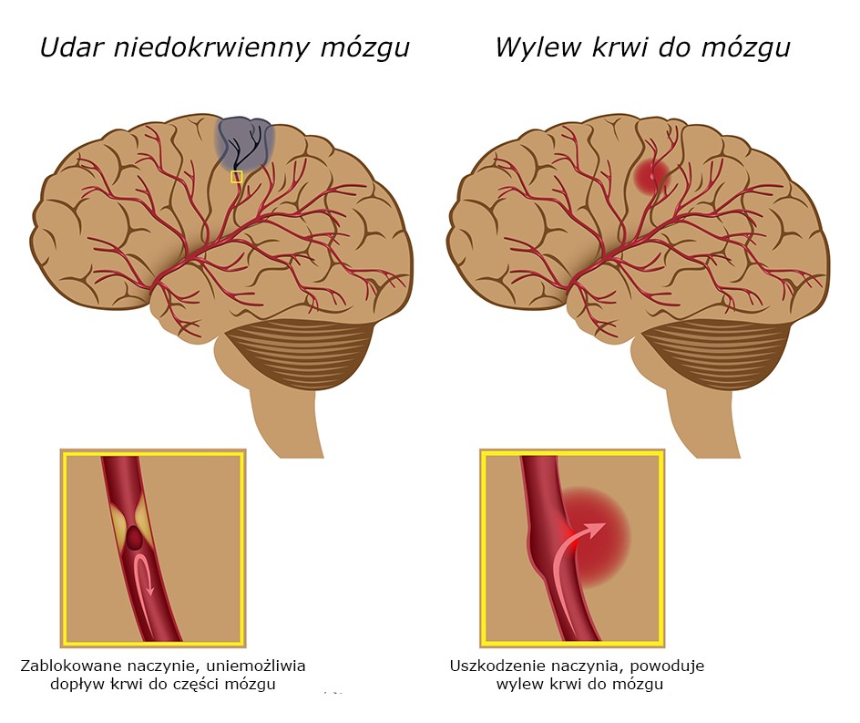 wylew