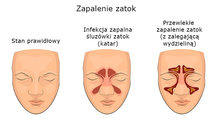 zapalenie zatok