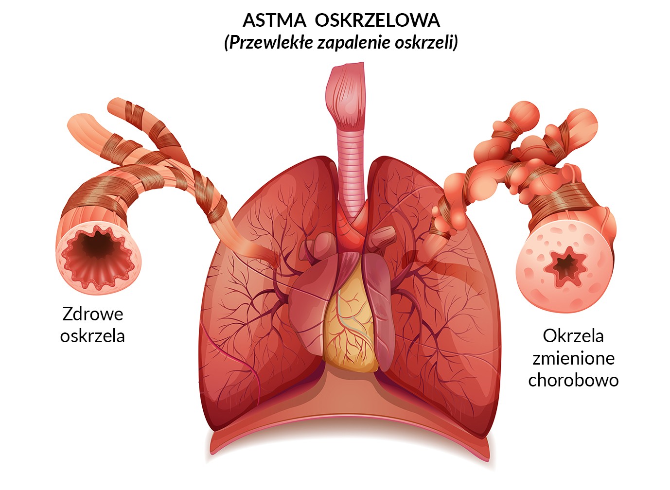astma