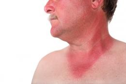 Dermatolog radzi - czyli kilka słów o bezpiecznym opalaniu 