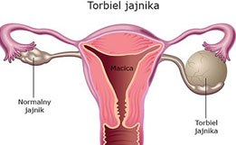 Torbiel jajnika - kiedy i jak leczyć?